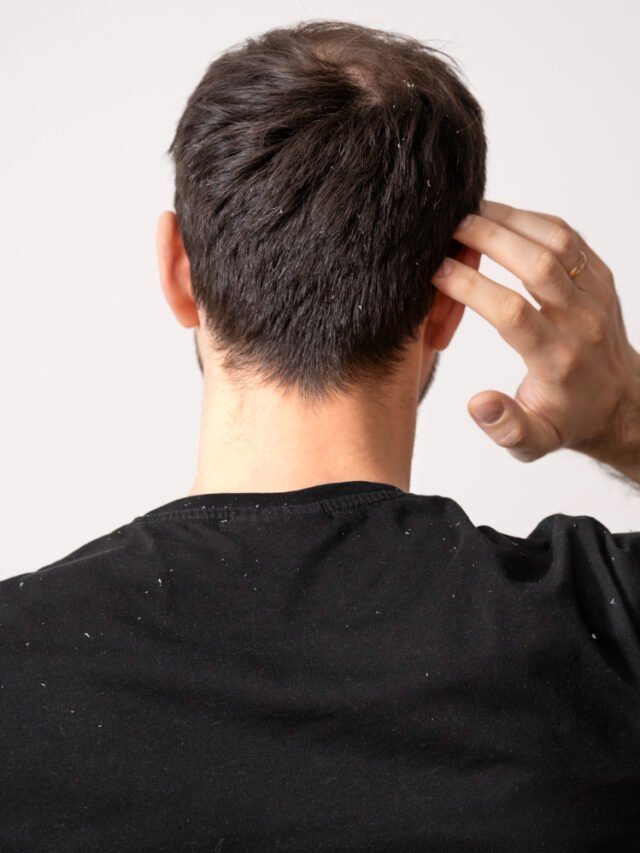 बालों से डैंड्रफ हटाने के आसान घरेलू उपाय  | home remedies for dandruff